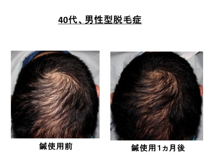 円形脱毛症　病院